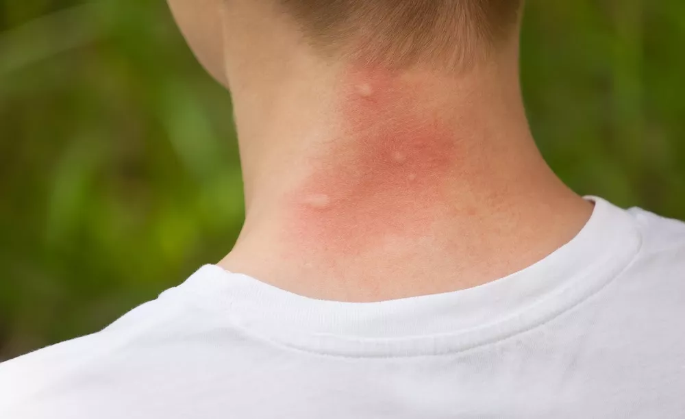 עקיצת יתוש - עקיצות יתוש בעורף